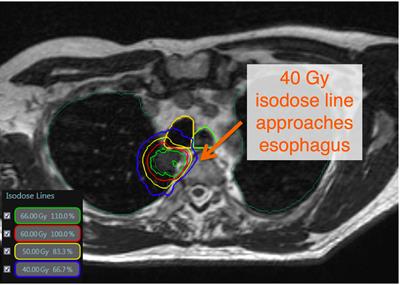 Adaptive hypofractionted and stereotactic body radiotherapy for lung tumors with real-time MRI guidance